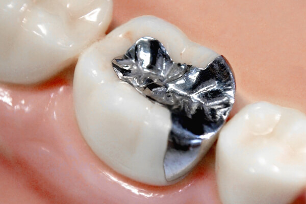 銀歯を白いセラミック歯に メタルフリー治療 洲本市